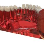 Implantes dentales en Las Rozas - Centro dental Heron